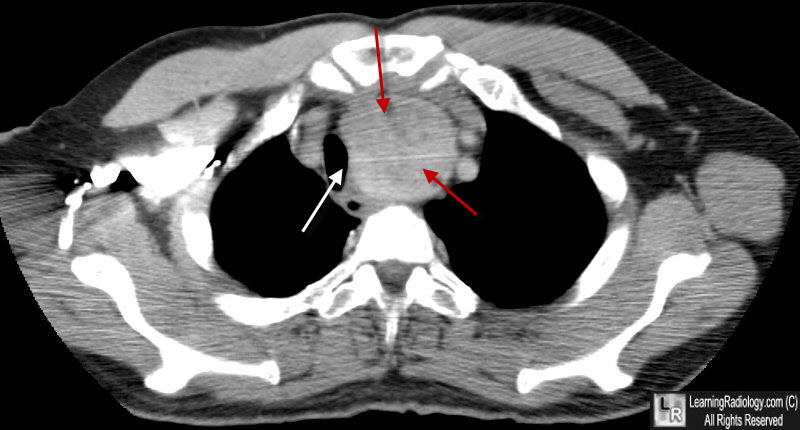 substernal thyroid